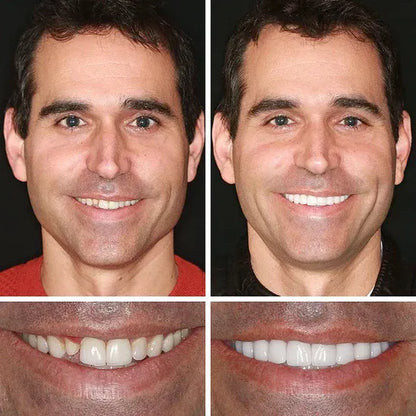 "🎁Ends Today: 70% OFF! ⏰Yagoo™ Medical Full Denture with Strong Suctiond🦷Obtain American Dental Association (ADA) Certification