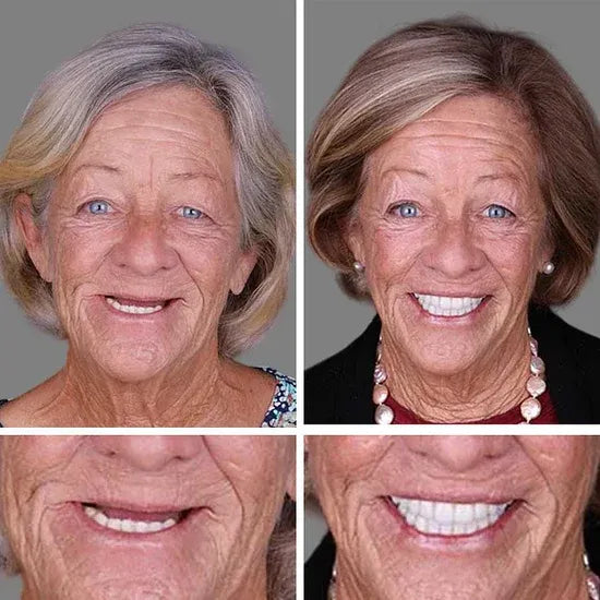 "🎁Ends Today: 70% OFF! ⏰Yagoo™ Medical Full Denture with Strong Suctiond🦷Obtain American Dental Association (ADA) Certification